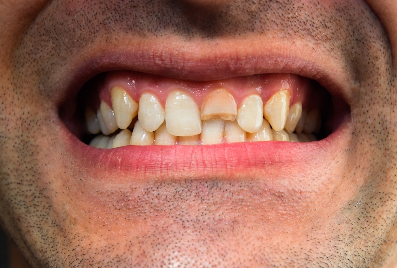 fractured tooth treatment