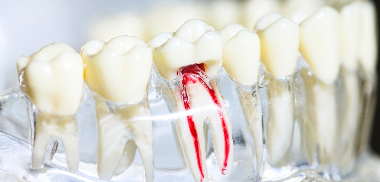 Root Canal vs. Extraction Which Is the Best Option for a Cracked Tooth
