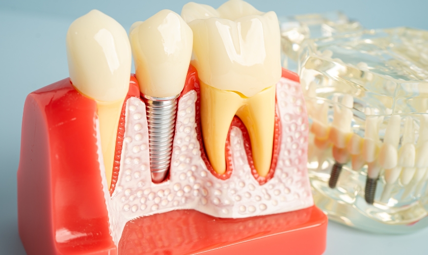 dental implants in Spring Hill